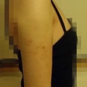 岳陽愛思特醫(yī)療美容醫(yī)院醫(yī)生王福生做手臂吸脂怎么樣？附案例效果圖