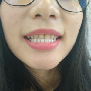 洛陽友好口腔醫(yī)院醫(yī)生李新然做牙貼面怎么樣？附案例效果圖