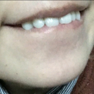 洛陽(yáng)友好口腔醫(yī)院醫(yī)生楊愛芳做牙齒冷光美白怎么樣？附案例效果圖