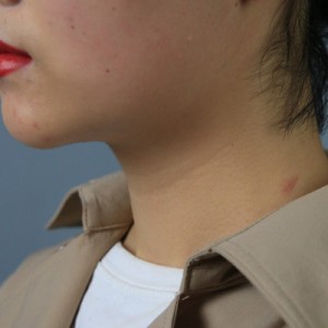 上海名媛醫(yī)療整形醫(yī)生閆嬌君做嗨體去頸紋效果怎么樣？附案例效果圖