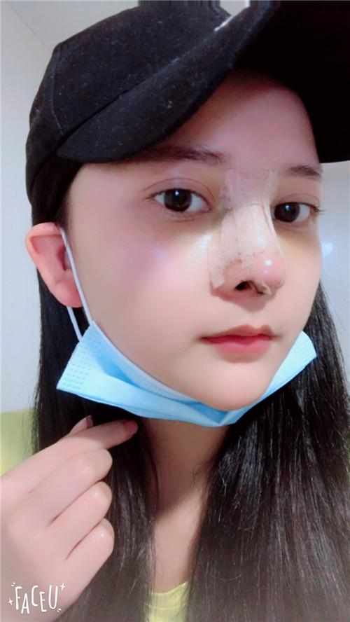 鄭州華領(lǐng)醫(yī)療美容醫(yī)院醫(yī)生張永濤做硅膠假體隆鼻怎么樣？附案例效果對比圖