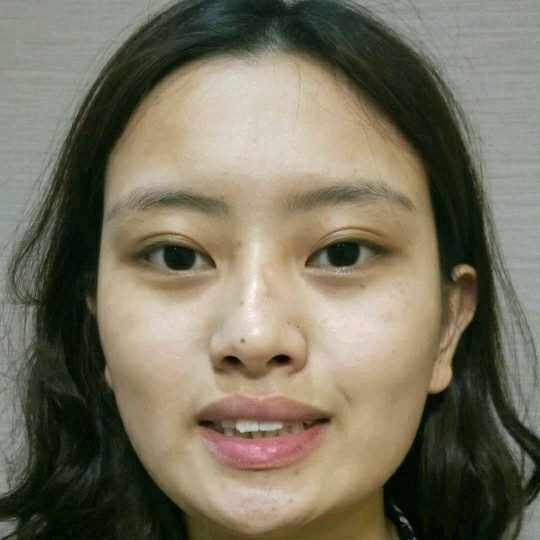 廣州愛來整形醫(yī)院醫(yī)生肖大衛(wèi)做激光點痣怎么樣？附案例效果對比圖