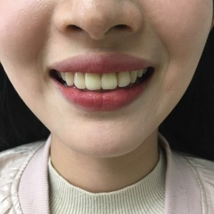 上?？仆呖谇会t(yī)院醫(yī)生鄧建儒做牙齒冷光美白怎么樣？附案例效果對(duì)比圖