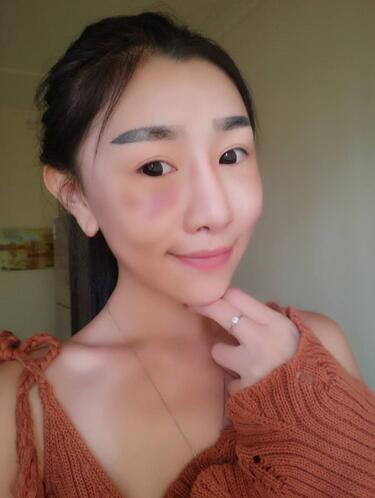 貴陽(yáng)泰康樂(lè)醫(yī)院整形美容科醫(yī)生陳璐做自體脂肪全臉填充效果怎么樣？