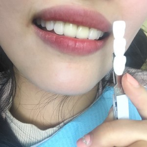 上?？仆呖谇会t(yī)院醫(yī)生鄧建儒做牙齒冷光美白怎么樣？附案例效果對比圖