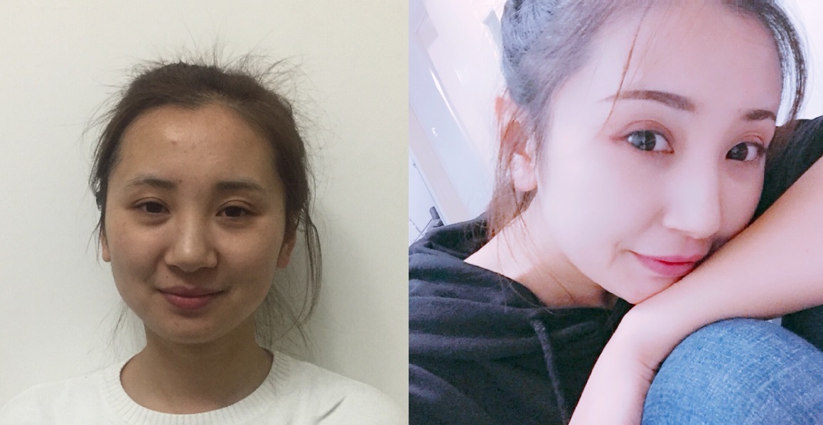 貴陽藝齡醫(yī)療美容門診部醫(yī)生李章做隆鼻手術(shù)怎么樣？附案例效果對比圖