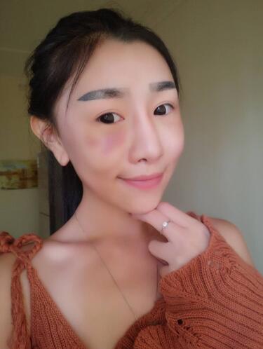 貴陽泰康樂醫(yī)院整形美容科醫(yī)生陳璐做自體脂肪全臉填充效果怎么樣？
