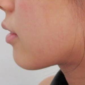 蚌埠韓美美萊整形醫(yī)院醫(yī)生張濤做玻尿酸墊下巴怎么樣？來(lái)看案例效果圖