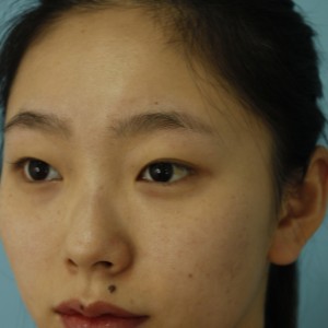 鄭州安格潤整形醫(yī)生楊曉紅做雙眼皮手術(shù)怎么樣？附案例效果圖