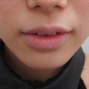 蚌埠韓美美萊整形醫(yī)院醫(yī)生張濤做玻尿酸墊下巴怎么樣？來(lái)看案例效果圖