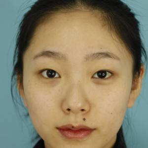 鄭州安格潤整形醫(yī)生楊曉紅做雙眼皮手術(shù)怎么樣？附案例效果圖