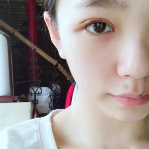 鄭州安格潤整形醫(yī)生楊曉紅做雙眼皮手術(shù)怎么樣？附案例效果圖