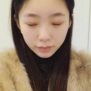 鄭州安格潤整形醫(yī)生楊曉紅做雙眼皮手術(shù)怎么樣？附案例效果圖