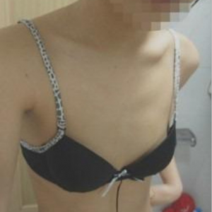 三亞圣迪亞整形美容醫(yī)院醫(yī)生韓超做假體隆胸怎么樣？附案例效果對比圖