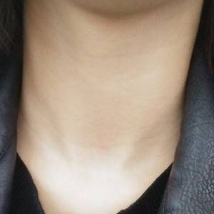 昭通愛麗諾整形醫(yī)生陳志江做嗨體去頸紋怎么樣？附案例效果圖