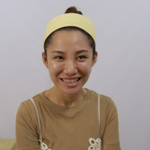 保定東陽口腔醫(yī)院醫(yī)生白小青做牙齒冷光美白怎么樣？附案例效果對比圖