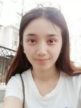 長(zhǎng)治松禾醫(yī)療美容診所醫(yī)生馬俊峰做韓式微創(chuàng)定點(diǎn)雙眼皮效果怎么樣？附案例