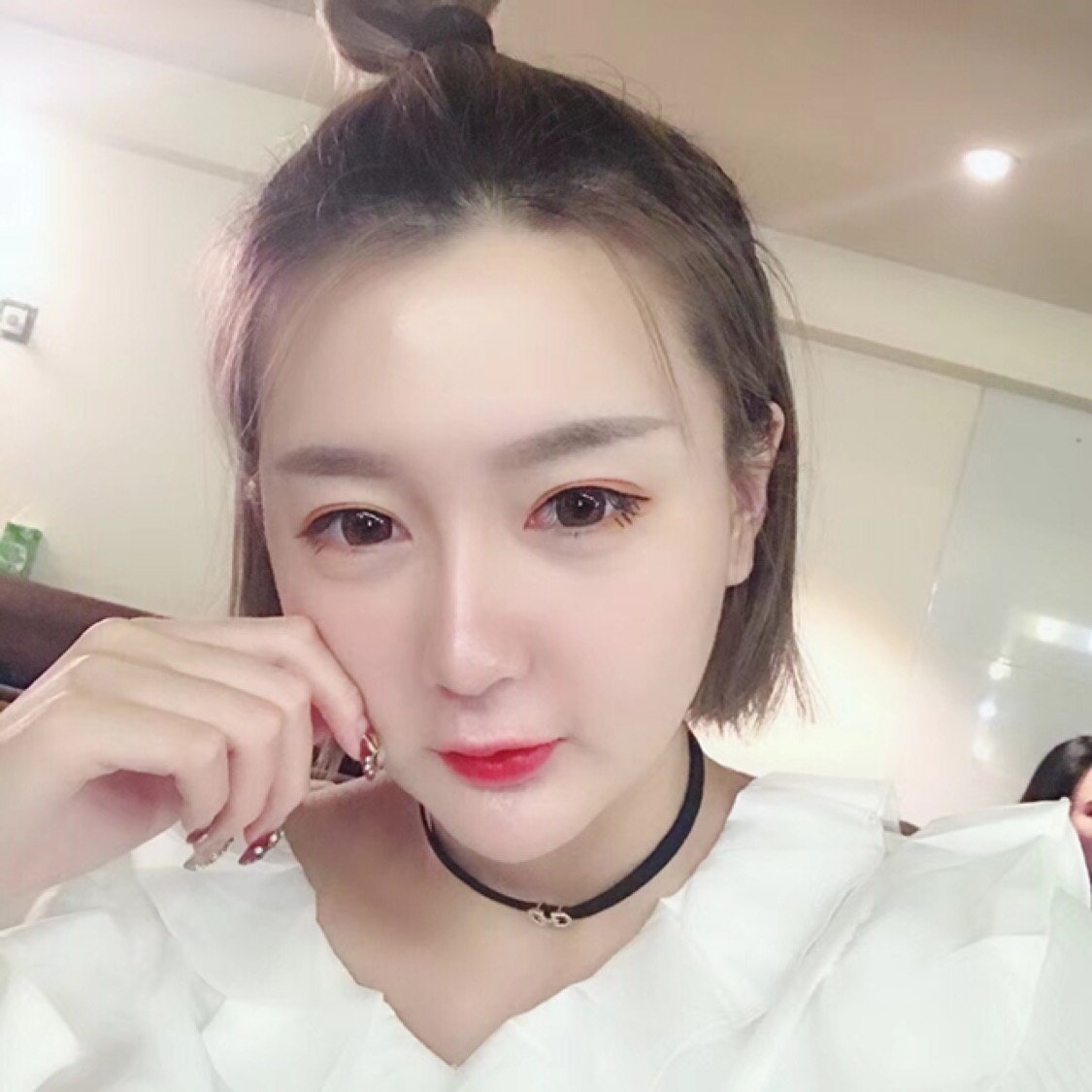 杭州格萊美整形美容醫(yī)院醫(yī)生張霞飛做自體脂肪全臉填充效果怎么樣？
