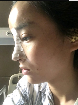 武漢米蘭醫(yī)療美容醫(yī)生柳再億做眼綜合+鼻綜合整形怎么樣？附真實(shí)案例對(duì)比圖