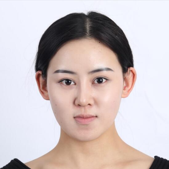 上海時光整形外科醫(yī)院醫(yī)生李靜林做假體隆鼻和反頜手術怎么樣？