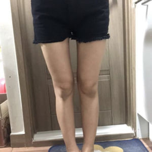 貴陽華美整形美容醫(yī)院醫(yī)生田永華做大腿吸脂效果怎么樣？附大腿吸脂案例前后對比圖