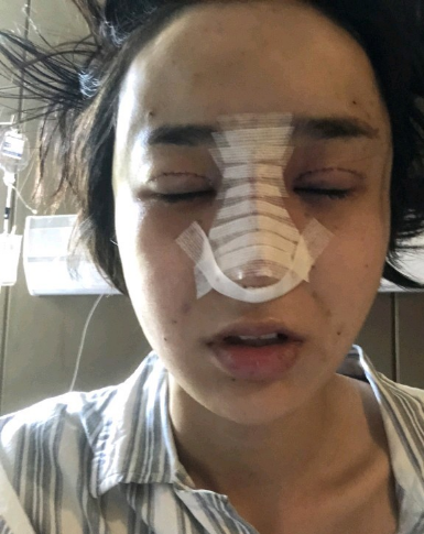 武漢米蘭醫(yī)療美容醫(yī)生柳再億做眼綜合+鼻綜合整形怎么樣？附真實(shí)案例對(duì)比圖