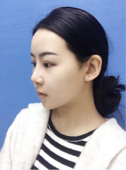 上海時(shí)光整形外科醫(yī)院醫(yī)生李靜林做假體隆鼻和反頜手術(shù)怎么樣？