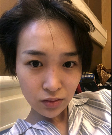武漢米蘭醫(yī)療美容醫(yī)生柳再億做眼綜合+鼻綜合整形怎么樣？附真實(shí)案例對(duì)比圖