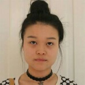 鄭州管城中醫(yī)院整形美容中心醫(yī)生張秀英做注射瘦臉怎么樣？附除皺瘦臉案例效果圖