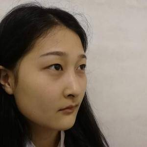 周口垣夢(mèng)醫(yī)療整形醫(yī)生王濤做切開(kāi)雙眼皮怎么樣？附切開(kāi)雙眼皮案例效果對(duì)比圖