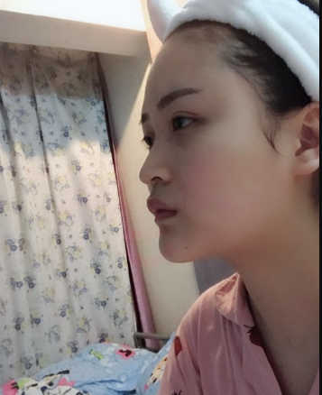 北京伊美爾美容愛康醫(yī)院醫(yī)生柳成做鼻綜合整形怎么樣？附案例效果圖