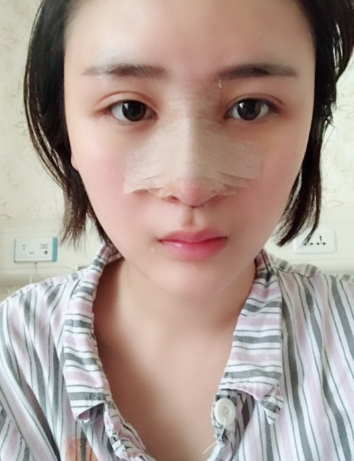 北京伊美爾美容愛(ài)康醫(yī)院醫(yī)生柳成做鼻綜合整形怎么樣？附案例效果圖