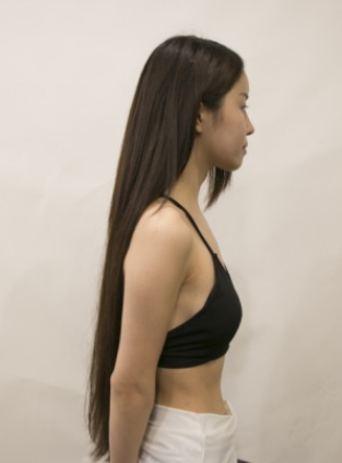 吉林現(xiàn)代整形美容醫(yī)院做假體隆胸效果怎么樣？附醫(yī)院案例效果對(duì)比圖