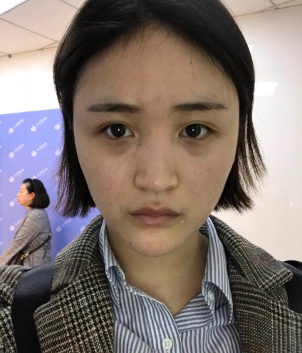 北京伊美爾美容愛(ài)康醫(yī)院醫(yī)生柳成做鼻綜合整形怎么樣？附案例效果圖