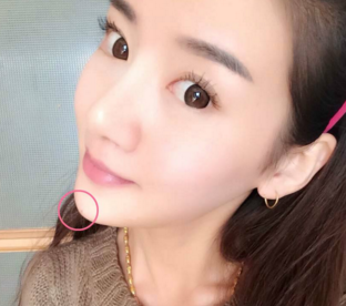 洛陽愛尚醫(yī)療美容門診部假體墊下巴