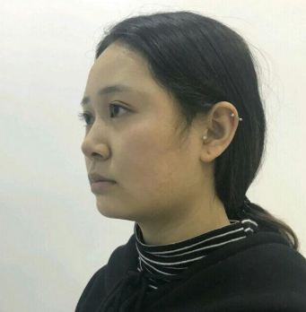 上海時(shí)光整形醫(yī)院做豐下巴怎么樣？許黎平醫(yī)生豐下巴案例分享