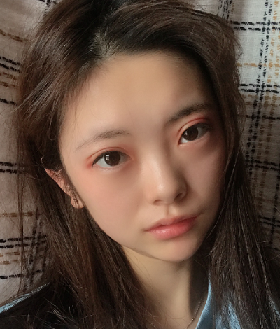 合肥韓美整形醫(yī)院做雙眼皮效果怎么樣?附石顯武醫(yī)生案例