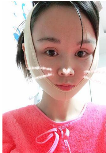 上海時(shí)光整形醫(yī)生何晉龍做下頜角磨骨術(shù)前術(shù)后案例效果對比圖