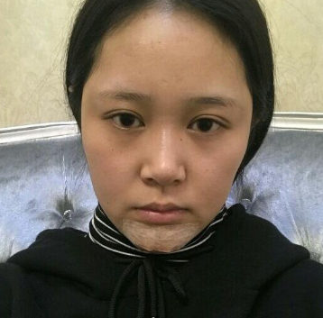 上海時(shí)光整形醫(yī)院做豐下巴怎么樣？許黎平醫(yī)生豐下巴案例分享