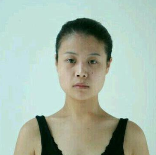 合肥韓美整形醫(yī)院做隆鼻手術效果怎么樣?附劉冷醫(yī)生隆鼻案例效果圖