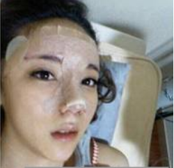 上海時光整形醫(yī)生何晉龍做假體隆鼻效果怎么樣？附案例效果對比圖