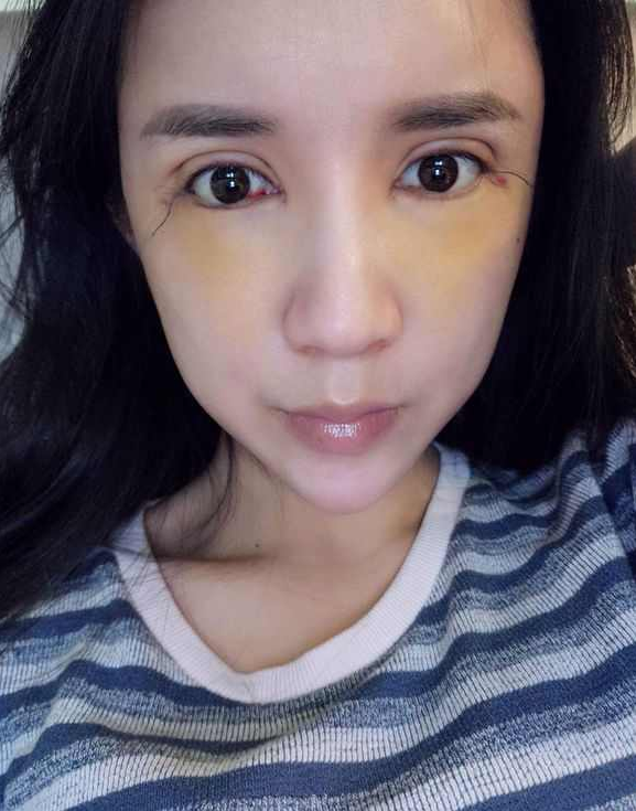 上海時(shí)光整形醫(yī)院張晶醫(yī)生做開(kāi)眼角怎么樣？附真實(shí)效果圖