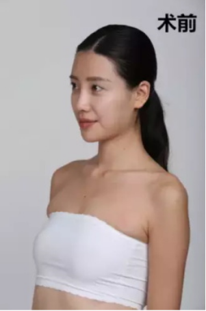 上海時(shí)光整形醫(yī)院何晉龍醫(yī)生做假體隆胸怎么樣？附案例對比圖