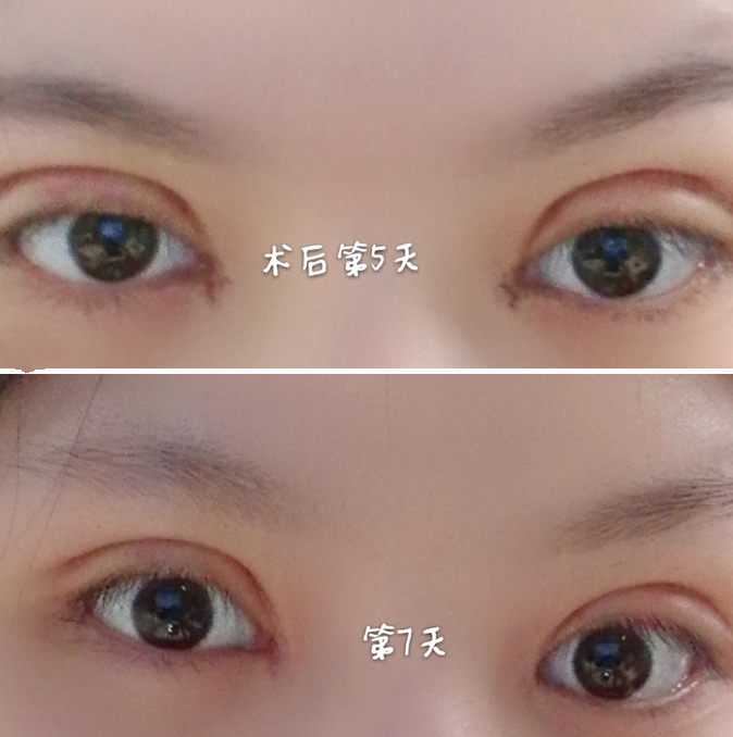 雙眼皮案例效果對(duì)比照
