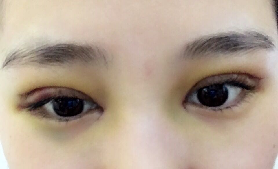 蚌埠韓美美萊整形醫(yī)生鄭捷做開眼角怎么樣？附案例效果圖