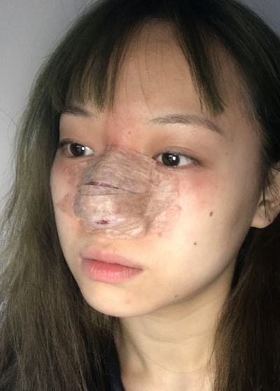 蚌埠韓美美萊整形做手術縮鼻頭效果怎么樣？附周娜醫(yī)生縮鼻頭案例效果圖
