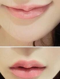 巴中時光醫(yī)學美容門診部做玻尿酸豐唇效果怎么樣？附李紅強豐唇案例