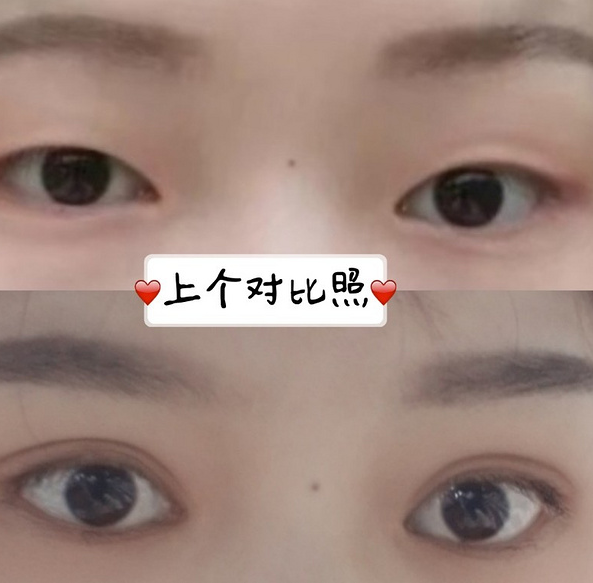鞍山菲之都醫(yī)療整形醫(yī)院做開眼角+全切雙眼皮效果怎么樣？附藺嬌婷醫(yī)生案例