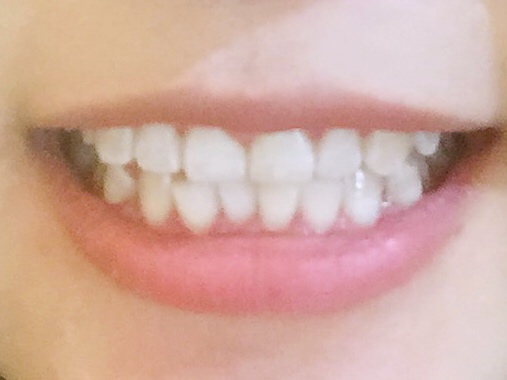 安慶渡江口腔醫(yī)院張良斌醫(yī)生做超聲波洗牙效果怎么樣？附洗牙案例效果圖