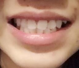 鞍山時(shí)代口腔門診部劉昕醫(yī)生做美容冠效果怎么樣？一起來看看吧